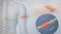 electroacupuncture for postherpetic neuralgia in a multicenter trial