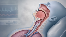 ketamine versus etomidate for tracheal intubation in critically ill adults
