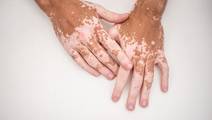Vitiligo