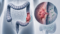 neoadjuvant chemotherapy vs upfront surgery in locally advanced colon cancer