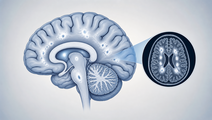 Rituximab Vs Ocrelizumab in Newly Diagnosed Relapsing MS