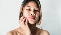 Atopic dermatitis
