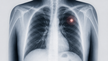 ai chest x ray prioritization did not shorten lung cancer pathway