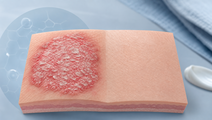 picankibart phase iii trial reports week 16 clearance and week 52 durability