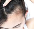 Hair Loss Treatment