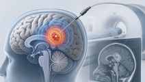 same session litt plus biopsy in unresectable glioblastoma