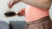 alopecia in pregnancy