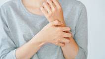 atopic dermatitis
