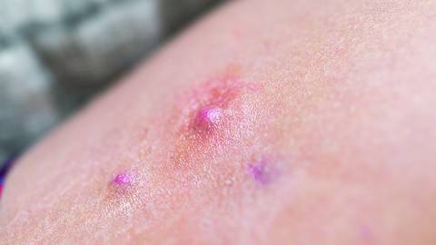 hidradenitis suppurativa