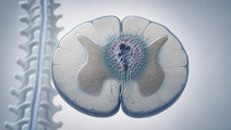 Spinal cord crosssection showing injury scar and limited axonal regrowth