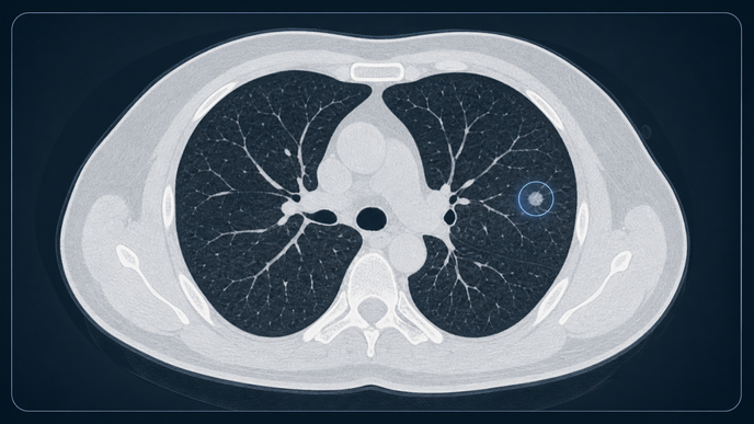 ai assisted lung nodule evaluation in low dose ct screening