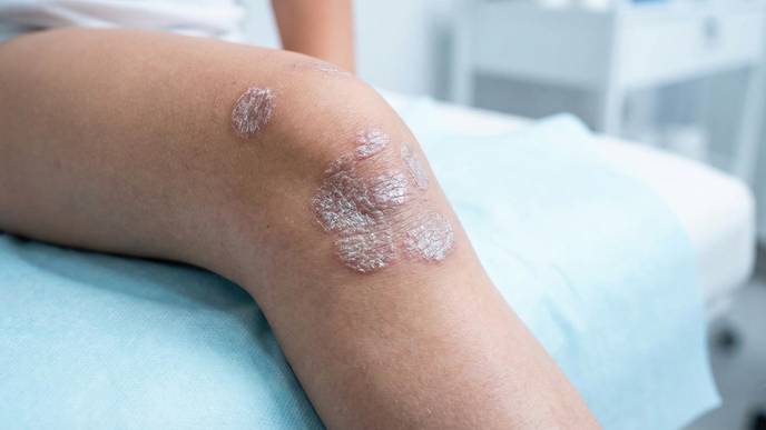 pediatric psoriasis