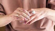Chronic Hand Eczema