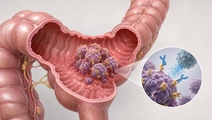 Stylized colon with TROP2 positive colorectal cancer cells and targeted therapy response