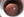 Figure 1. The lens is dislocated in this patient with MFS.