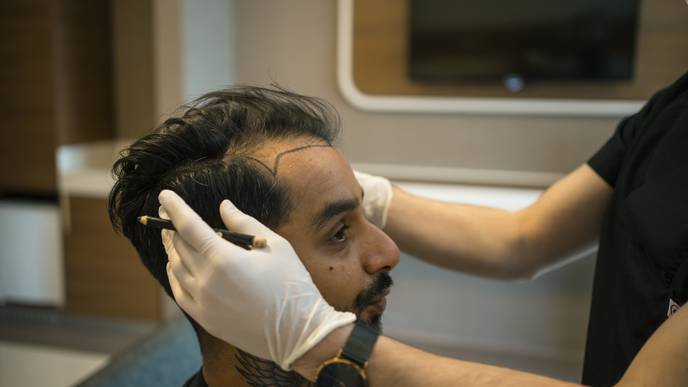 hair transplantation via iStock