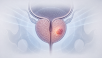 can 2409 plus radiotherapy extends disease free survival