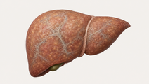 once monthly efimosfermin alfa in mash with f2 f3 fibrosis