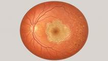 gildeuretinol acetate in geographic atrophy what the saga trial reported