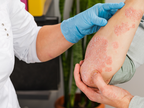 Addressing Adherence Challenges in Moderate-to-Severe Plaque Psoriasis Manageme…