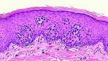 SKIN CANCER