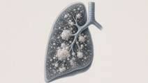 CT Clues Distinguish Pseudomonas From Aspergillosis