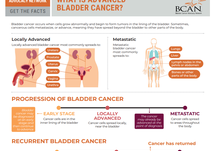 What Is Advanced Bladder Cancer