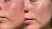 facial rejuvenation
