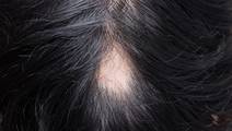 alopecia