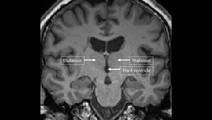 MS Minute Cognitive Dysfunction in People Living with Multiple Sclerosis