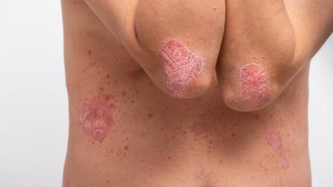 Psoriasis