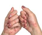 psoriasis