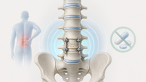 Simplified lumbar spine showing postoperative analgesia after lumbar fusion surgery