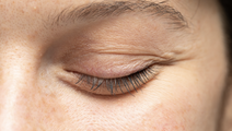 Blepharoplasty