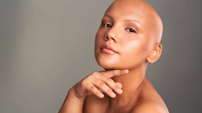 Alopecia areata