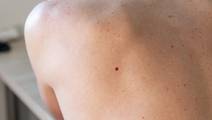 cherry angioma