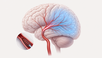 choice 2 trial intra arterial alteplase after thrombectomy