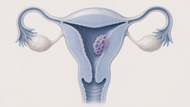 avelumab plus methotrexate in low risk gestational trophoblastic neoplasia