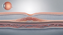 Illustrated macular cross section showing abnormal retinal vessels associated with wet age related macular degeneration