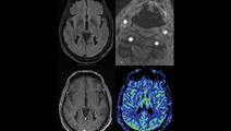 Critical Bilateral Carotid Artery Disease Presenting as Hemichorea