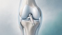 Illustrated knee joint with highlighted reconstructed anterior cruciate ligament