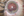 Figure 4. Vitreous had adhered to the temporal iris.