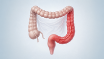 Simplified large intestine with subtle colon inflammation representing ulcerative colitis before elective colectomy
