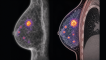 Trop2 targeted PET CT imaging of breast cancer lesions with clear tumor contrast
