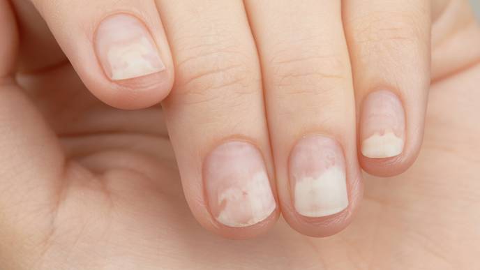 Onycholysis