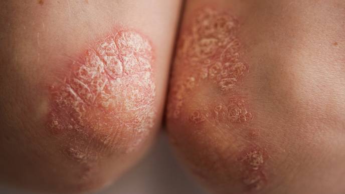 plaque psoriasis