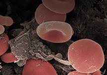 COVID-19 Challenges: Vascular Clotting & Catheter Clogging