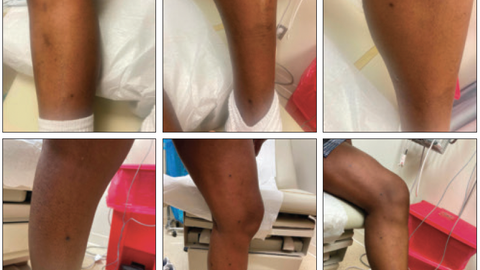 Multiple Eruptive Myxoid Dermatofibromas in Patient With History of HIV