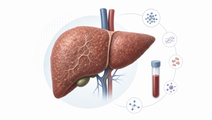 Simplified liver with fibrosis cues and lab markers for chronic hepatitis B fibrosis assessment