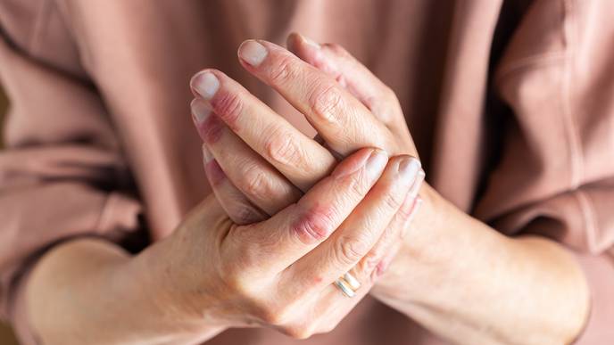 atopic dermatitis